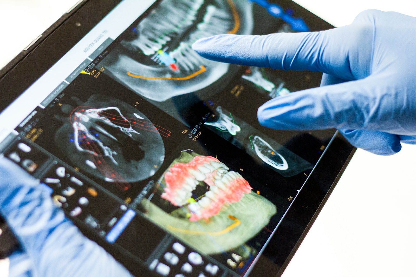Dentist reviewing a 3D dental scan with a patient during an implant consultation in West Palm Beach