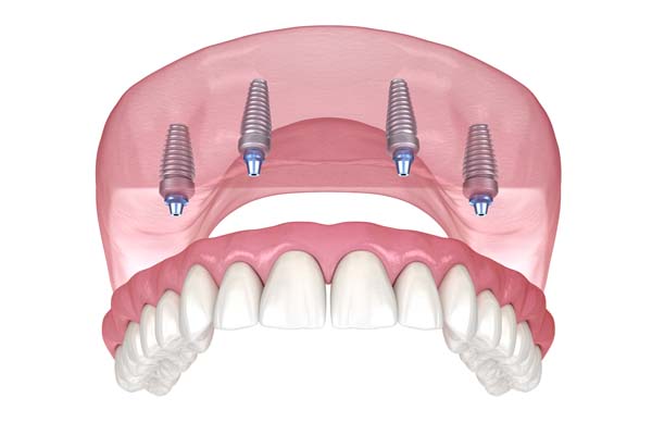 What Is All On  ® And How Can It Replace Missing Teeth?