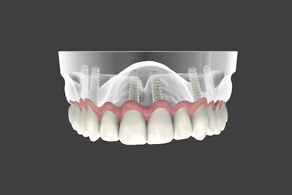 Are Implant Supported Dentures Permanent from Palm Beach Institute of Dentistry in West Palm Beach, FL