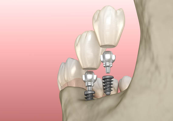 Dental Implant Procedure: Bone Graft, Placement, And Restoration