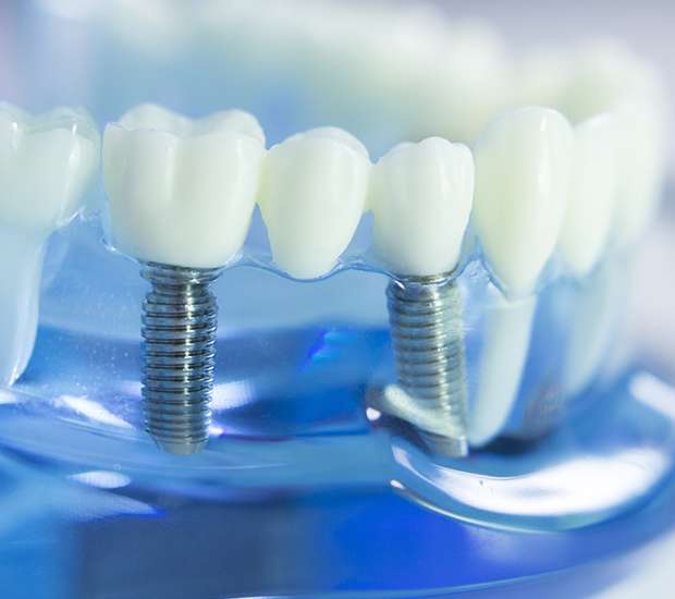 West Palm Beach Dental Implants