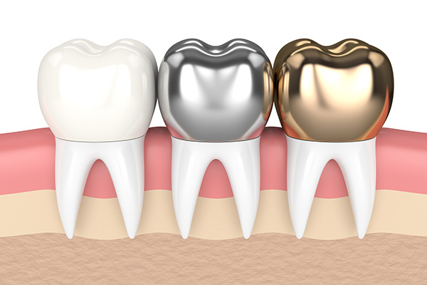 Metal Crowns vs. Porcelain Dental Crowns from Palm Beach Institute of Dentistry in West Palm Beach, FL