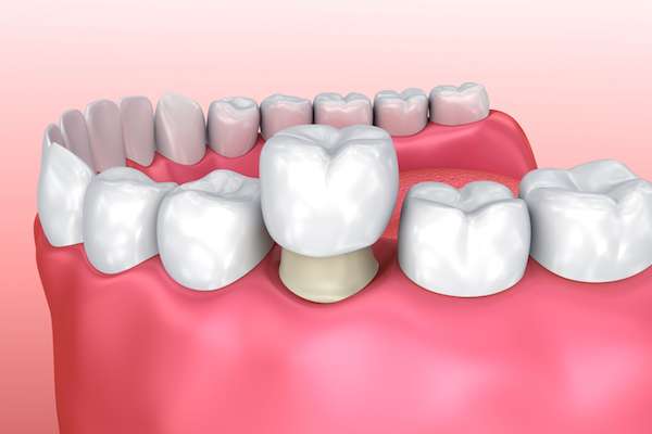 Permanent Dental Crowns vs. Temporary: Is There a Difference from Palm Beach Institute of Dentistry in West Palm Beach, FL