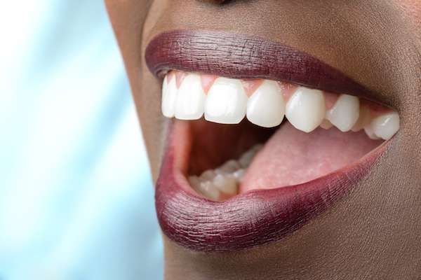 Routine Dental Care: What Are Tooth Colored Fillings from Palm Beach Institute of Dentistry in West Palm Beach, FL